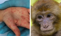 Diagnosticul de variola maimuței se infirmă. Pacientul român stabilit în Marea Britanie are varicelă